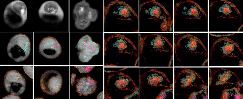 holotomography-microscopy-reveals-novel-cholesterol