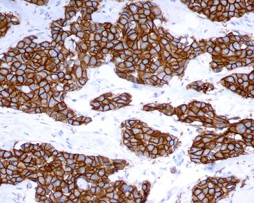 Bond Oracle HER2 IHC System, an example of 3+ staining intensity on breast cancer tissue